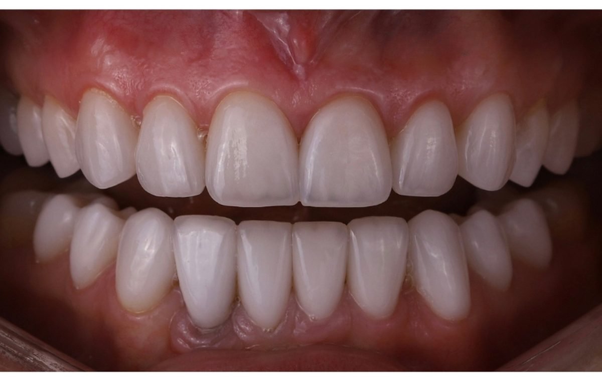 After treatment