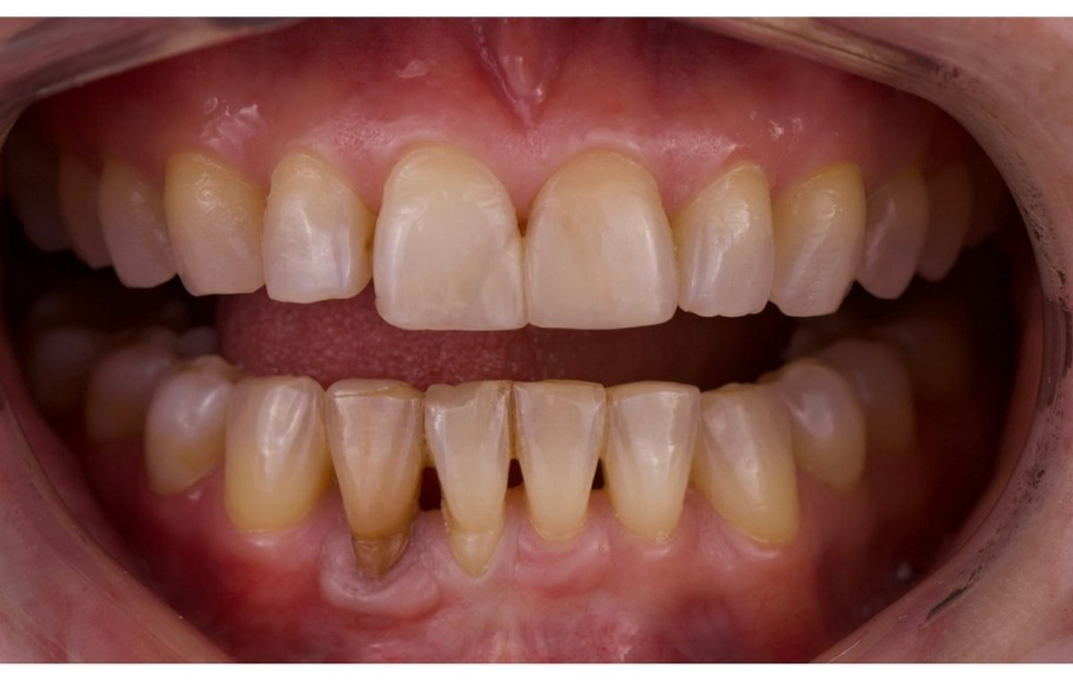 Before treatment