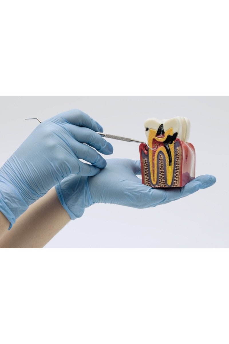Cross-section tooth model showing decay reaching the root canals, examined with a dental probe
