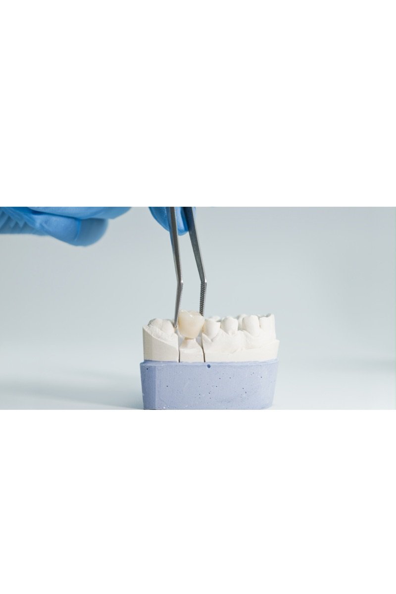 A natural-looking ceramic crown fitted onto a dental model